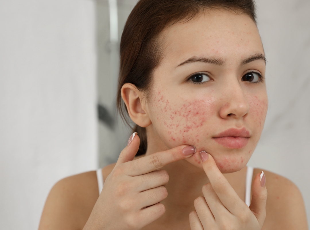 Abordagens Modernas para o Tratamento da Acne: Além dos Cremes e Loções Convencionais