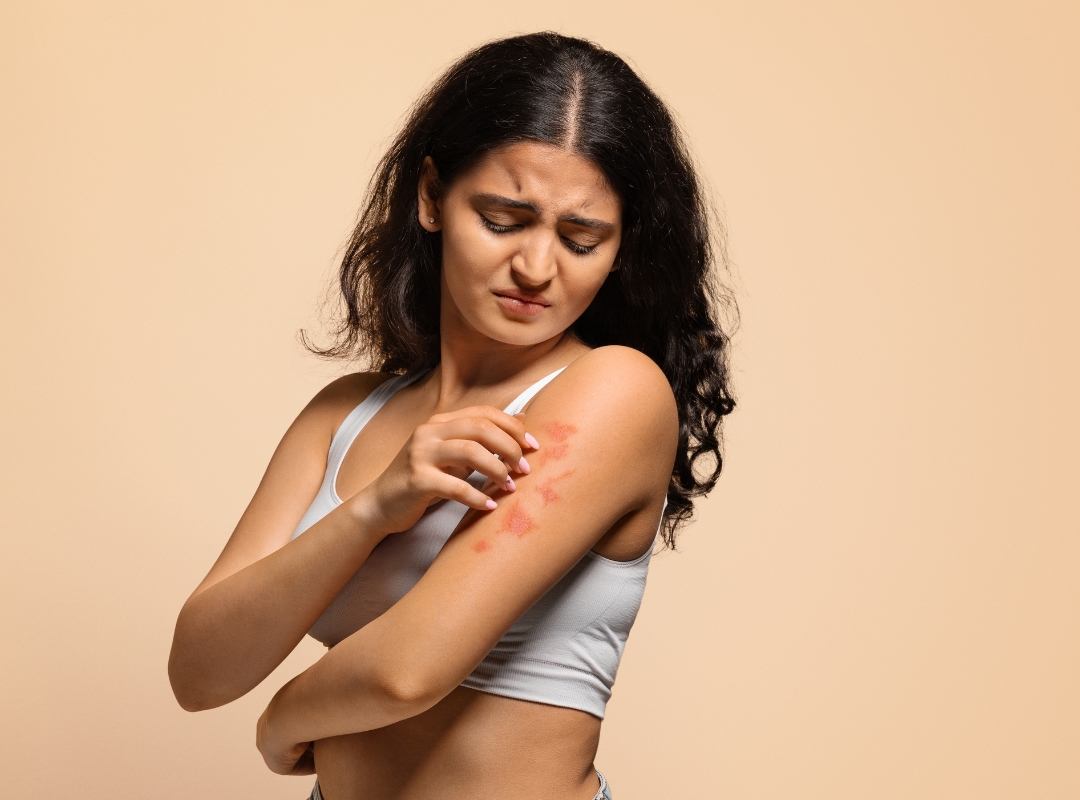 Psoríase: O Impacto na Sua Vida e Como Lidar com Isso