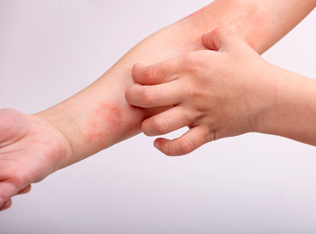 Por Que Você Não Deve Ignorar a Dermatite Atópica?