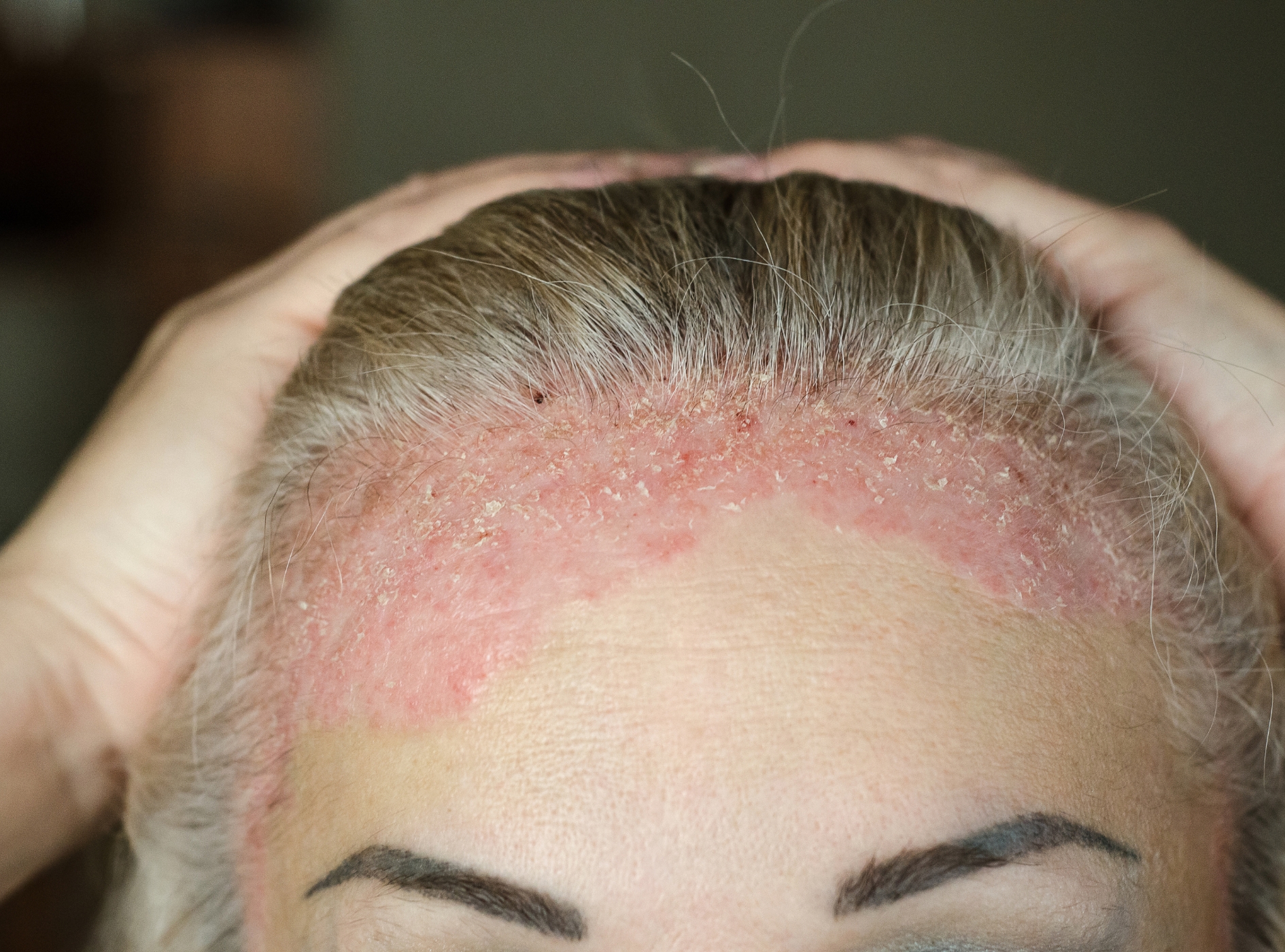 Psoríase: O Que Funciona Realmente no Tratamento da Doença