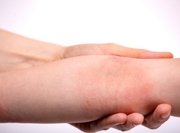 Por Que Tanta Gente Demora Anos Para Descobrir Que Tem Dermatite Atópica?