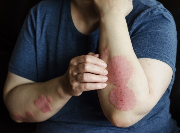 5 Verdades Que Ninguém Te Contou Sobre o Controle da Psoríase