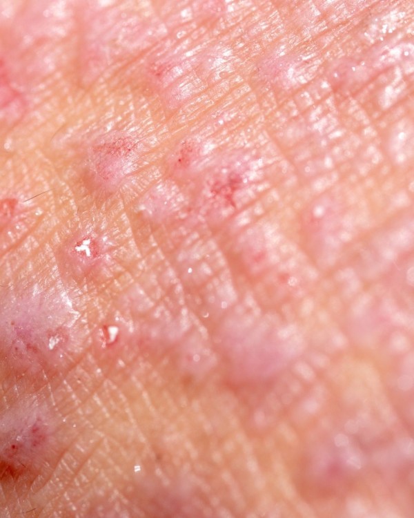 Dermatite atópica e verão