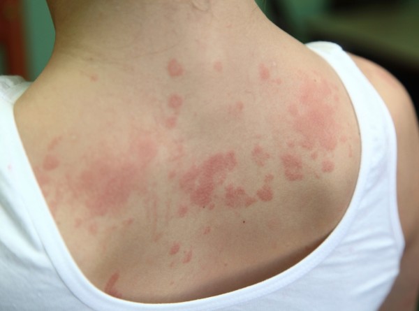 7 Mitos Sobre Dermatite Atópica Que Estão Atrapalhando Seu Tratamento